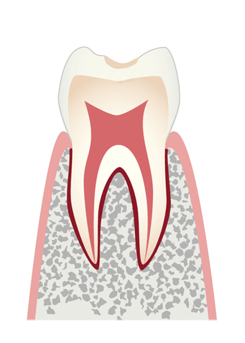 C0.初期の虫歯