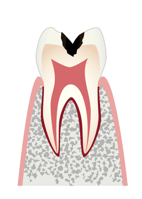 C2.歯の内部まで進行した虫歯