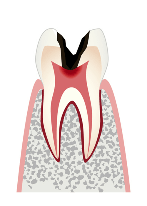 C3.歯髄（神経）まで進行した虫歯
