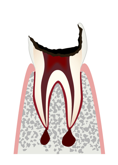 C4.歯冠が大きく失われた歯